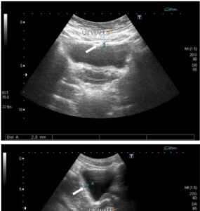 bladder ultrasound